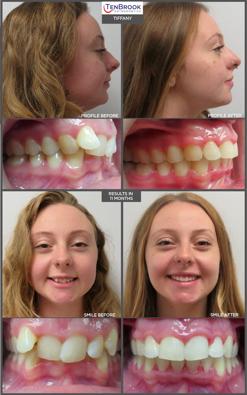 Braces Before And After Smile